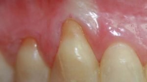 periodontitis