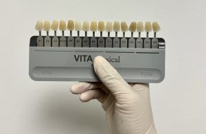 Dientes limados para carillas