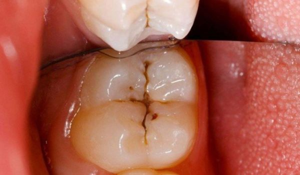 aspirina-para-caries-770x434-1
