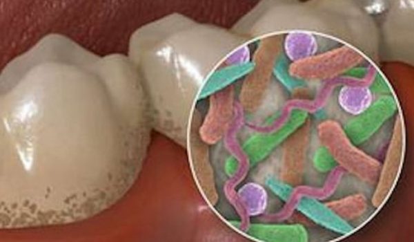 bacterias-caries-dentales-770x434-1
