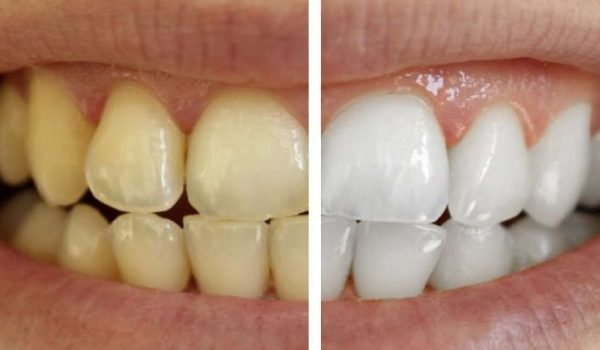 productos para blanqueamiento dental