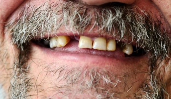 diabetes-perdida-de-dientes-770x434-1