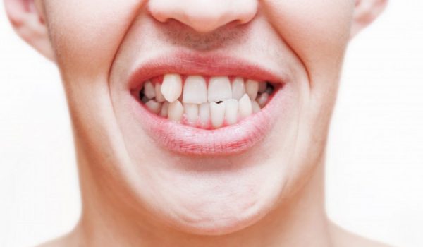 dientes torcidos