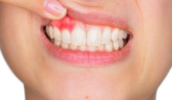 fistula-dental-770x434