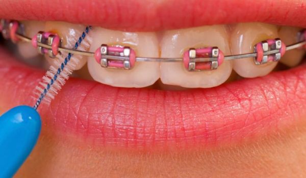 limpieza-brackets-770x434