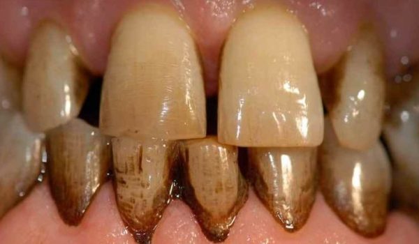 manchas-dentales-770x434-1