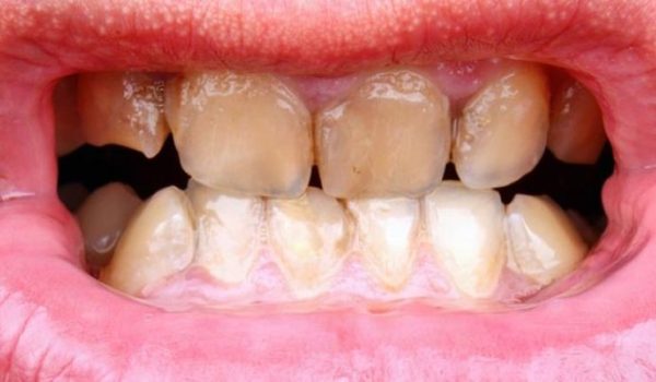 manchas-en-dientes-770x434-1