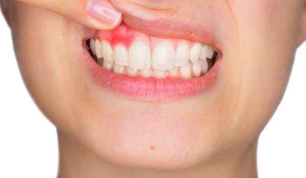 odontalgia