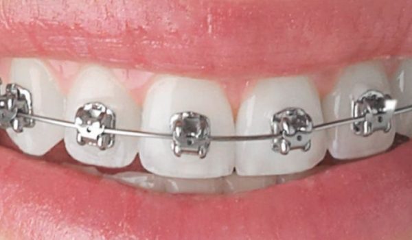 ortodoncia-brackets-1-770x434
