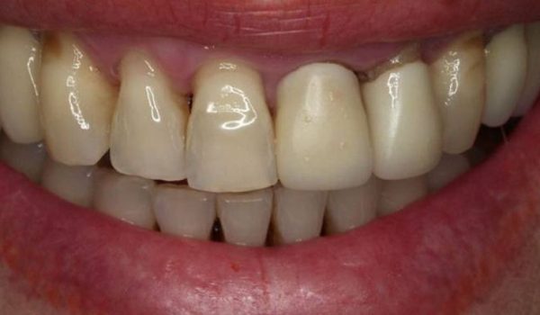 periodontitis-menopausia-770x434-1