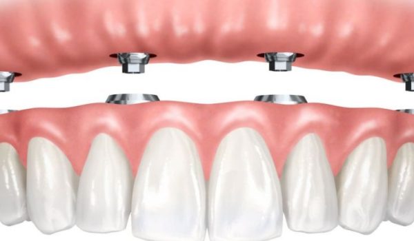 puentes-dentales-770x434-1