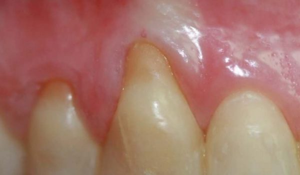 periodontitis